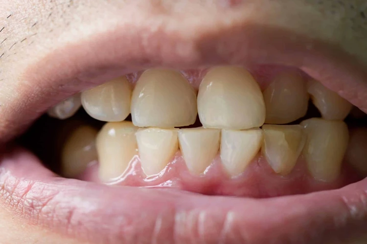 O Que Significa Sonhar Com Dente Sujo?