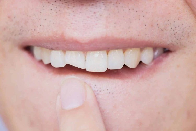 Explicação Dos Simbolismos Dos Dentes