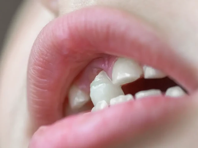 O Que Significa Sonhar Com Dentes Bons Caindo?